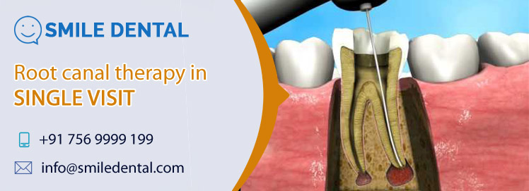 Single visit root canal therapy