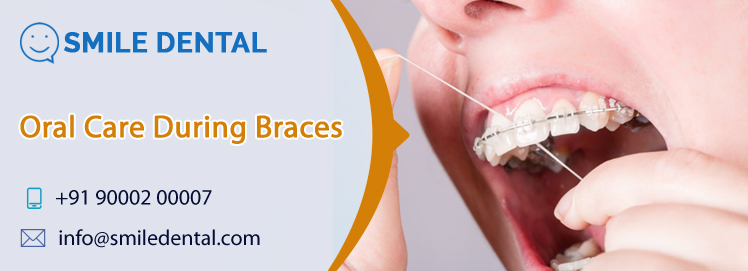 Oral care during braces